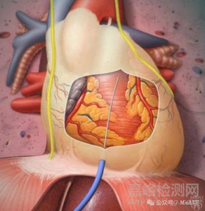 【創(chuàng)新醫(yī)械】PeriCut：微創(chuàng)心包穿刺治療心衰，術(shù)后肺動脈楔壓降低24%
