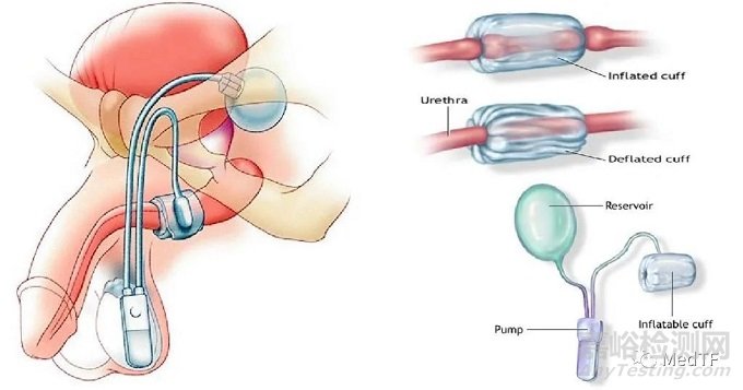 【創(chuàng)新醫(yī)械】UroRelief：讓尿失禁患者自主控制排尿的硅膠閥，可逆手術(shù)