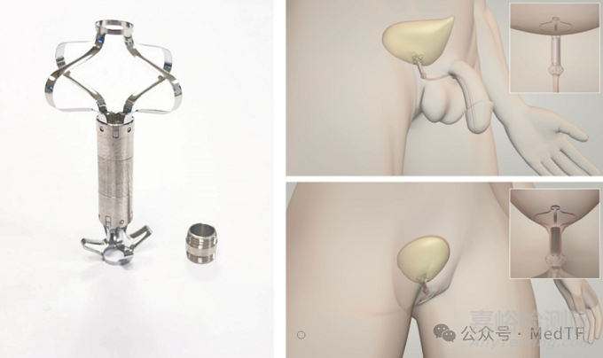 【創(chuàng)新醫(yī)械】UroRelief：讓尿失禁患者自主控制排尿的硅膠閥，可逆手術(shù)