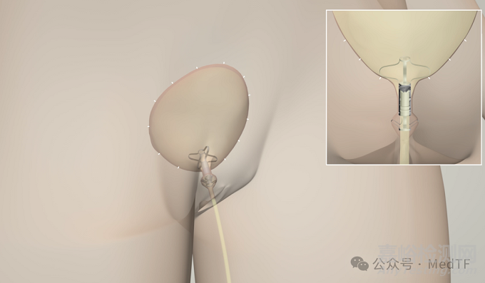 【創(chuàng)新醫(yī)械】UroRelief：讓尿失禁患者自主控制排尿的硅膠閥，可逆手術(shù)