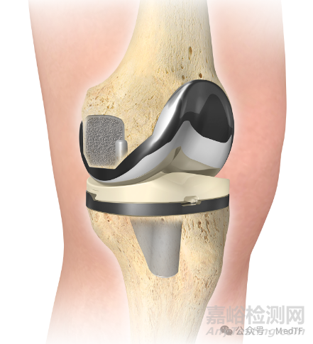 全球首款智能膝關(guān)節(jié)Persona IQ的臨床研究結(jié)果