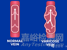 【創(chuàng)新醫(yī)械】VCD：可吸收靜脈閉合器，下肢靜脈曲張有效解決方案