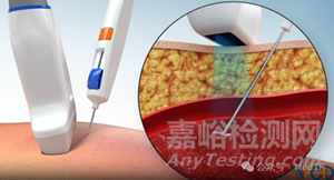 【創(chuàng)新醫(yī)械】VCD：可吸收靜脈閉合器，下肢靜脈曲張有效解決方案