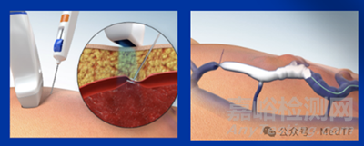 【創(chuàng)新醫(yī)械】VCD：可吸收靜脈閉合器，下肢靜脈曲張有效解決方案