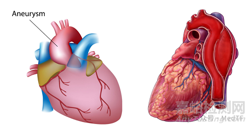 【創(chuàng)新醫(yī)械】Complion：具備天然血管一樣彈性的主動脈人工血管