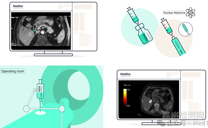 【創(chuàng)新醫(yī)械】YntraDose-90：可經(jīng)皮注射放射性微球，治療胰腺癌