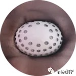 【創(chuàng)新醫(yī)械】CLAAS ：泡沫基質(zhì)左心耳封堵器