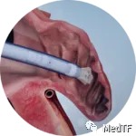 【創(chuàng)新醫(yī)械】CLAAS ：泡沫基質(zhì)左心耳封堵器