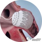 【創(chuàng)新醫(yī)械】CLAAS ：泡沫基質(zhì)左心耳封堵器