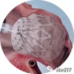 【創(chuàng)新醫(yī)械】CLAAS ：泡沫基質(zhì)左心耳封堵器