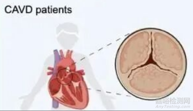 智維心創(chuàng)新醫(yī)械沖擊波瓣膜治療系統(tǒng)技術(shù)解析