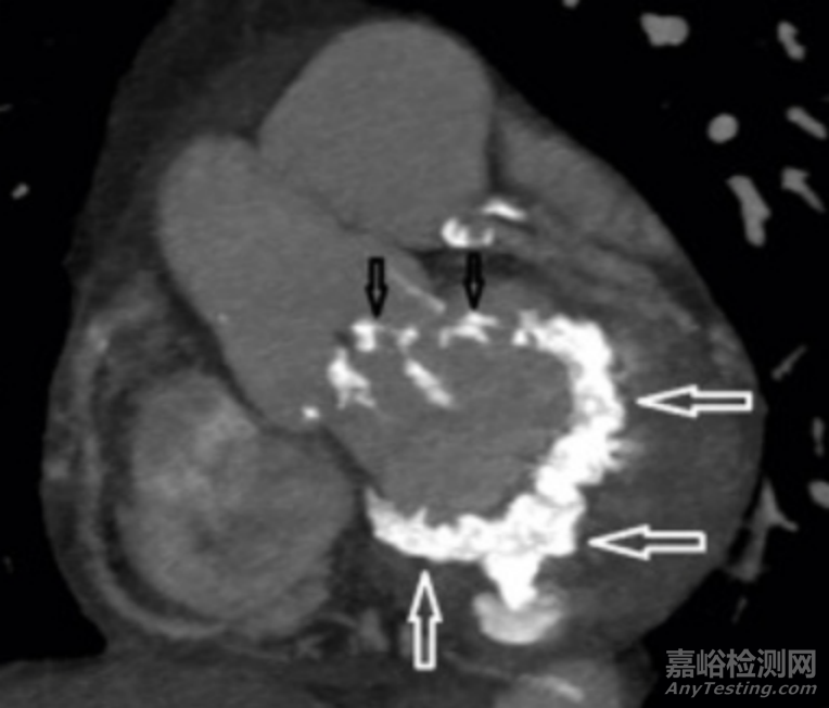 智維心創(chuàng)新醫(yī)械沖擊波瓣膜治療系統(tǒng)技術(shù)解析