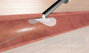 【創(chuàng)新醫(yī)械】全球首個無縫合全降解大口徑血管閉合器