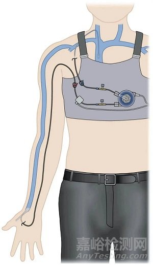 【創(chuàng)新醫(yī)械】Amplifi：靜脈擴張器獲FDA突破性器械認定