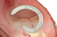 美敦力三尖瓣成形帶獲批上市