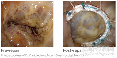 美敦力三尖瓣成形帶獲批上市
