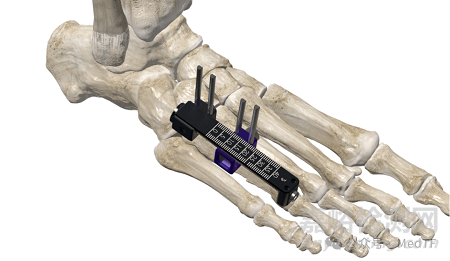 創(chuàng)新醫(yī)械】Brachiator：捷邁邦美齊推出新型足踝固定系統(tǒng)，解決復(fù)雜的小骨重建需求