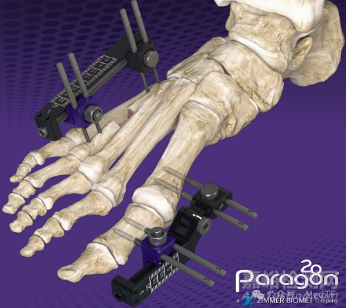 創(chuàng)新醫(yī)械】Brachiator：捷邁邦美齊推出新型足踝固定系統(tǒng)，解決復(fù)雜的小骨重建需求